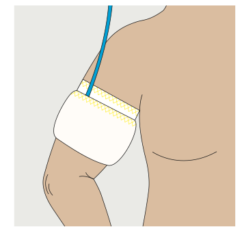Tourniquet Sleeve / Rein verpackt, zum Einmalgebrauch /  ≤ 30 cm / blau / 10 St. p.P. / REF: 23-00-710